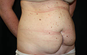 Tummy Tuck Before & After Patient #24625