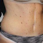 Tummy Tuck Before & After Patient #24625