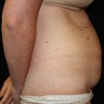Tummy Tuck Before & After Patient #24625