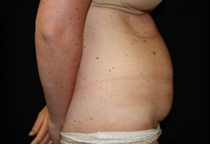 Tummy Tuck Before & After Patient #24625