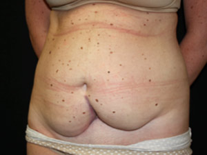 Tummy Tuck Before & After Patient #24625