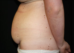 Tummy Tuck Before & After Patient #24625