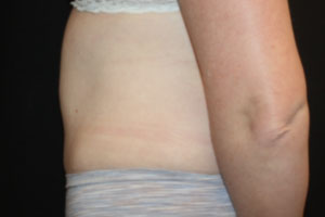 Tummy Tuck Before & After Patient #24642