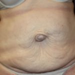 Tummy Tuck Before & After Patient #24642