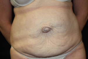 Tummy Tuck Before & After Patient #24642