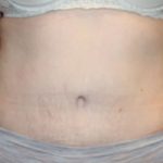 Tummy Tuck Before & After Patient #24642