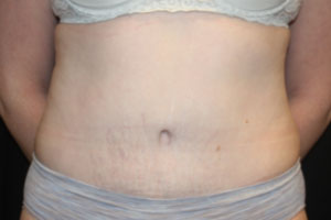 Tummy Tuck Before & After Patient #24642