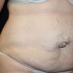 Tummy Tuck Before & After Patient #24642