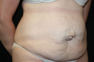 Tummy Tuck Before & After Patient #24642