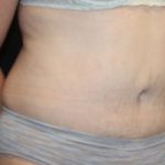 Tummy Tuck Before & After Patient #24642