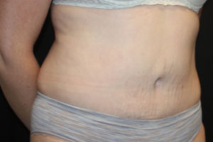 Tummy Tuck Before & After Patient #24642