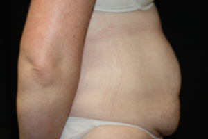 Tummy Tuck Before & After Patient #24642