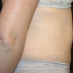 Tummy Tuck Before & After Patient #24642