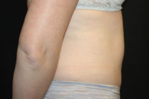 Tummy Tuck Before & After Patient #24642