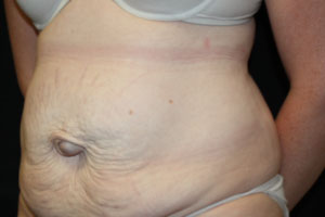 Tummy Tuck Before & After Patient #24642