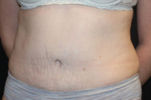 Tummy Tuck Before & After Patient #24642