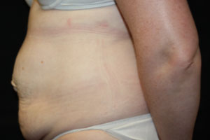 Tummy Tuck Before & After Patient #24642