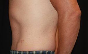 Tummy Tuck Before & After Patient #24643