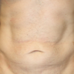 Tummy Tuck Before & After Patient #24643