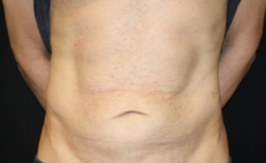 Tummy Tuck Before & After Patient #24643