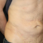 Tummy Tuck Before & After Patient #24643