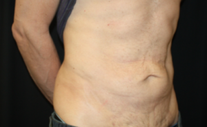 Tummy Tuck Before & After Patient #24643