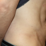 Tummy Tuck Before & After Patient #24643