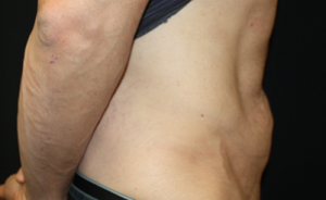 Tummy Tuck Before & After Patient #24643