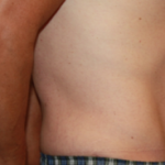 Tummy Tuck Before & After Patient #24643