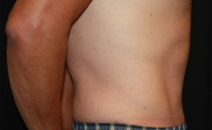 Tummy Tuck Before & After Patient #24643