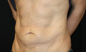 Tummy Tuck Before & After Patient #24643
