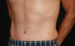 Tummy Tuck Before & After Patient #24643