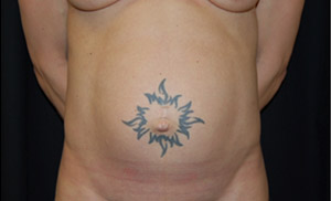 Tummy Tuck Before & After Patient #24664