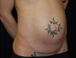 Tummy Tuck Before & After Patient #24664