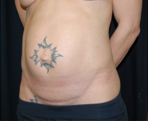 Tummy Tuck Before & After Patient #24664