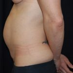 Tummy Tuck Before & After Patient #24664