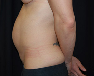 Tummy Tuck Before & After Patient #24664