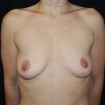 Breast Augmentation - Round Silicone Implants Before & After Patient #20433