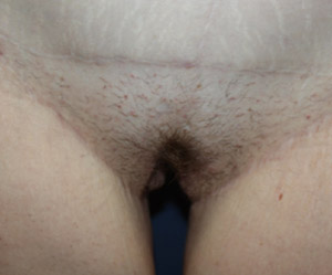 Labiaplasty Before & After Patient #21393