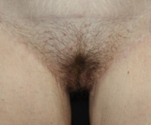 Labiaplasty Before & After Patient #21393