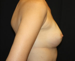 Breast Implant Exchange Before & After Patient #20738
