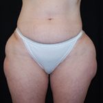 Liposuction Before & After Patient #21442