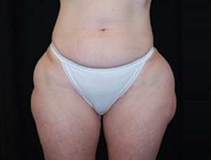 Liposuction Before & After Patient #21442