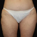 Liposuction Before & After Patient #21442