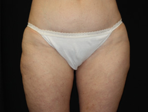 Liposuction Before & After Patient #21442