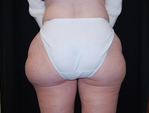 Liposuction Before & After Patient #21442