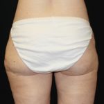 Liposuction Before & After Patient #21442