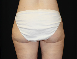 Liposuction Before & After Patient #21442