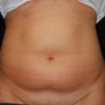 Liposuction Before & After Patient #22977