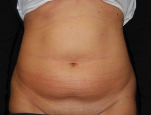 Liposuction Before & After Patient #22977